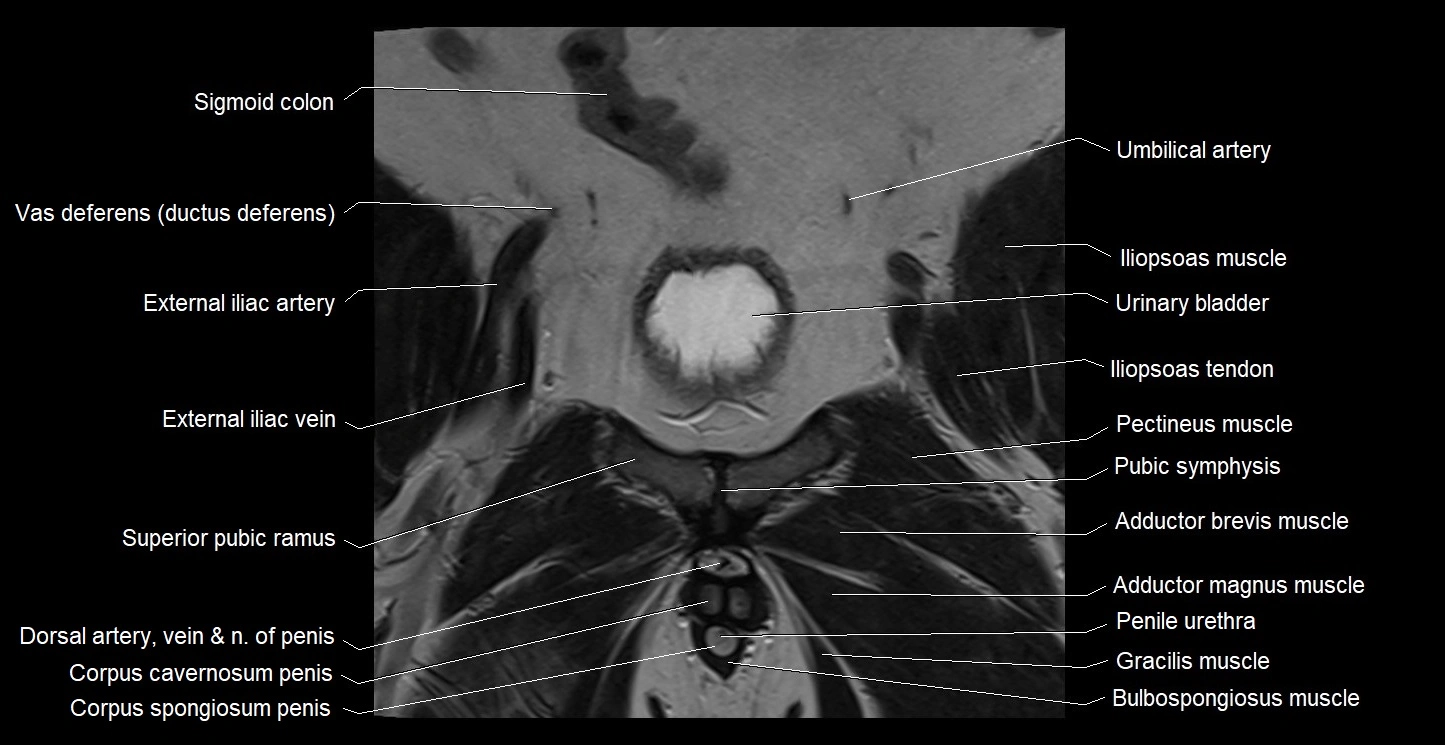 MRI coronal cross sectional anatomy male pelvis image 10.webp